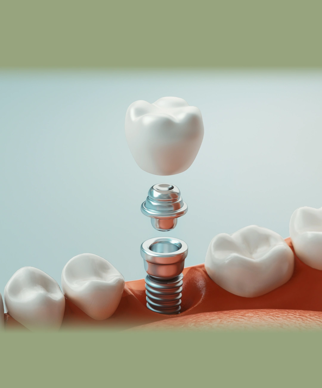 Banner da página Implantodontia